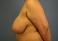 Breast Surgery  Case 431 - Breast Reduction