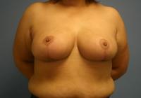 Breast Surgery  Case 431 - Breast Reduction