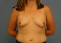 Breast Surgery  Case 441 - Breast Augmentation