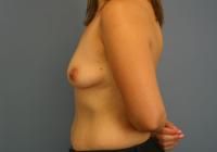 Breast Surgery  Case 441 - Breast Augmentation