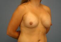 Breast Surgery  Case 441 - Breast Augmentation