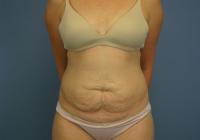 Body Contouring  Case 461 - Tummy Tuck