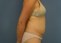 Body Contouring  Case 461 - Tummy Tuck