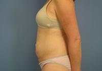 Body Contouring  Case 461 - Tummy Tuck