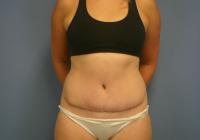 Body Contouring  Case 461 - Tummy Tuck