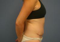 Body Contouring  Case 461 - Tummy Tuck