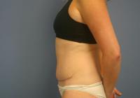 Body Contouring  Case 461 - Tummy Tuck