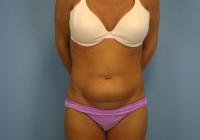 Body Contouring  Case 481 - Tummy Tuck
