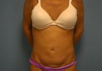 Body Contouring  Case 481 - Tummy Tuck