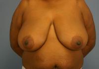 Breast Surgery  Case 491 - Breast Reduction