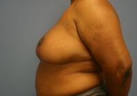 Breast Surgery  Case 491 - Breast Reduction