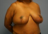Breast Surgery  Case 491 - Breast Reduction