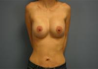 Breast Surgery  Case 501 - Breast Augmentation