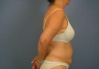 Body Contouring  Case 511 - Liposuction