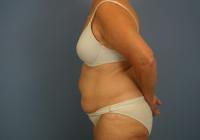 Body Contouring  Case 511 - Liposuction