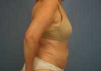 Body Contouring  Case 511 - Liposuction