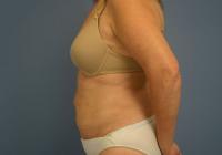 Body Contouring  Case 511 - Liposuction