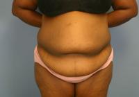 Body Contouring  Case 521 - Tummy Tuck