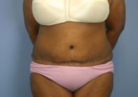 Body Contouring  Case 521 - Tummy Tuck