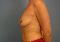 Breast Surgery  Case 531 - Breast Augmentation