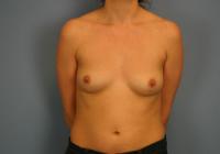 Breast Surgery  Case 541 - Breast Augmentation