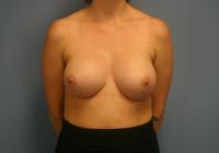 Breast Surgery  Case 541 - Breast Augmentation