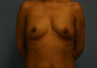 Breast Surgery  Case 561 - Breast Augmentation