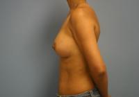 Breast Surgery  Case 561 - Breast Augmentation