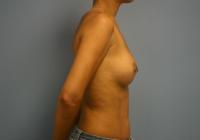 Breast Surgery  Case 561 - Breast Augmentation