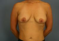 Breast Surgery  Case 571 - Breast Augmentation