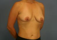 Breast Surgery  Case 571 - Breast Augmentation