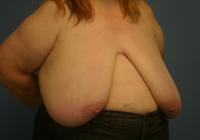 Breast Surgery  Case 581 - Breast Reduction