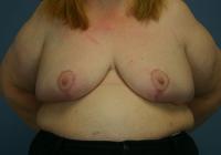 Breast Surgery  Case 581 - Breast Reduction