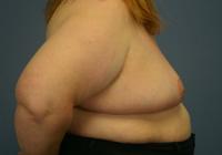 Breast Surgery  Case 581 - Breast Reduction