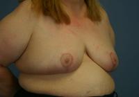 Breast Surgery  Case 581 - Breast Reduction