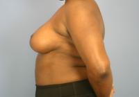 Breast Surgery  Case 591 - Breast Reduction