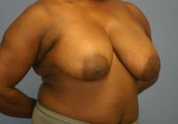 Breast Surgery  Case 591 - Breast Reduction
