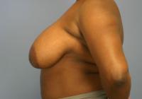 Breast Surgery  Case 591 - Breast Reduction