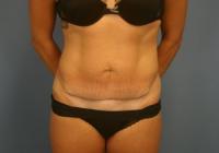 Body Contouring  Case 621 - Tummy Tuck