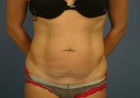 Body Contouring  Case 621 - Tummy Tuck