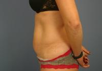 Body Contouring  Case 621 - Tummy Tuck