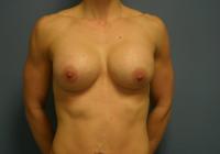 Breast Surgery  Case 631 - Breast Augmentation