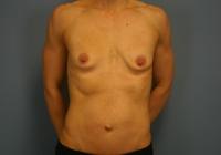 Breast Surgery  Case 631 - Breast Augmentation