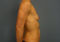 Breast Surgery  Case 631 - Breast Augmentation