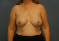 Breast Surgery  Case 641 - Breast Implant Revision