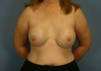 Breast Surgery  Case 641 - Breast Implant Revision