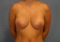 Breast Surgery  Case 651 - Breast Augmentation