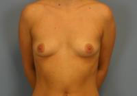 Breast Surgery  Case 651 - Breast Augmentation
