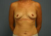 Breast Surgery  Case 661 - Breast Augmentation