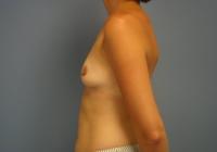 Breast Surgery  Case 661 - Breast Augmentation